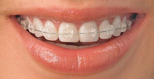 chi-phi-nieng-rang-mac-cai-su-bao-nhieu-tien11